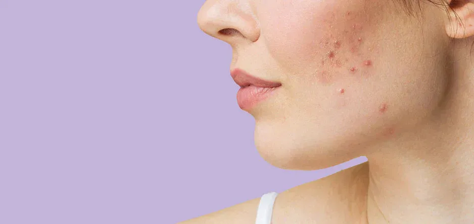 Scopri di più sull'articolo Olio CBD per problemi cutanei